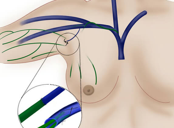 How is immediate lymphatic reconstruction done