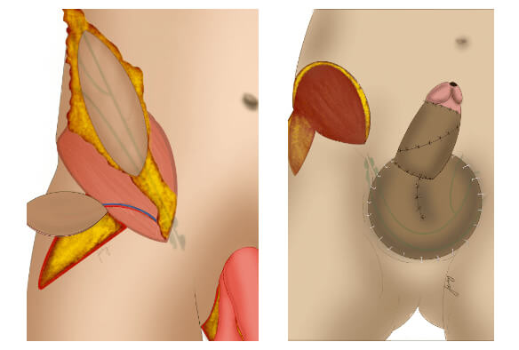 Lymph vessel flaps