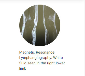 Lymphedema diagnostic scans