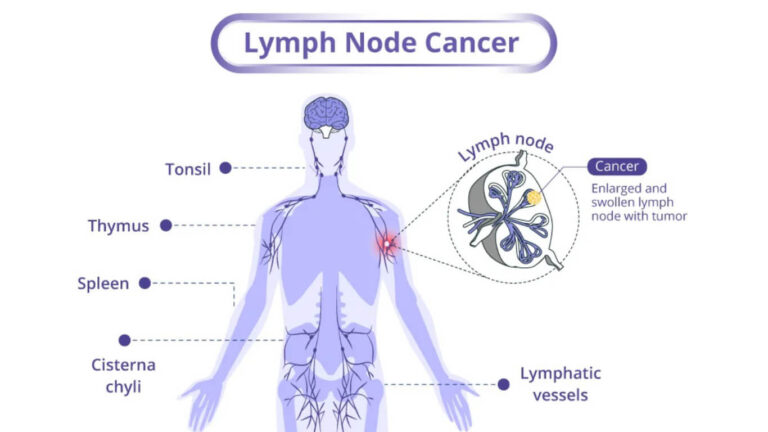 Lymphoma