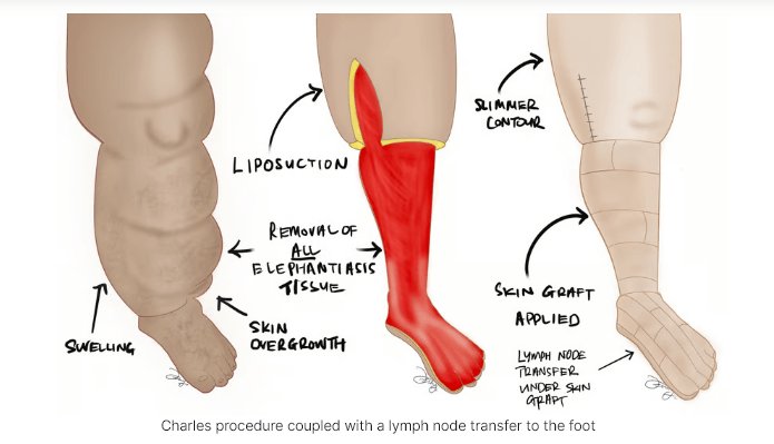 Treat lymphedema early