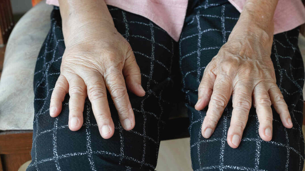 Understanding Lymphedema in the Hands