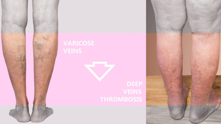 chronic secondary lymphedema