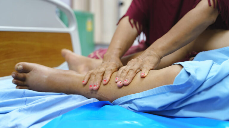 combined decongestive therapy