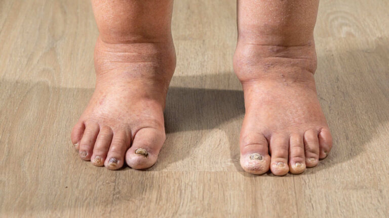 congenital lymphedema causes