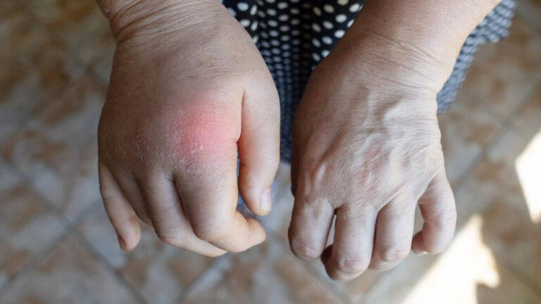 difference between lymphedema and lipedema