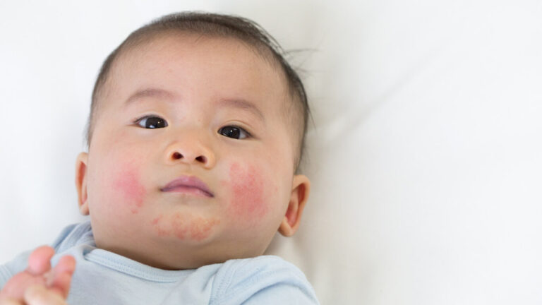 differential diagnosis of skin rash in pediatrics