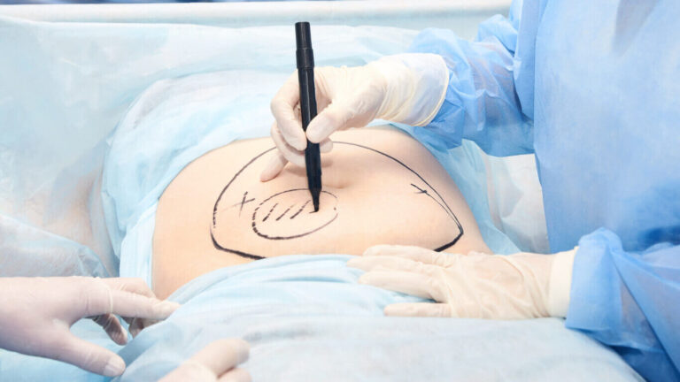 lymphedema liposuction