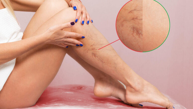lymphedema tree bark skin on legs