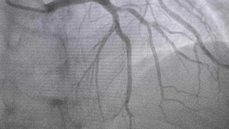 nuclear medicine lymphangiogram
