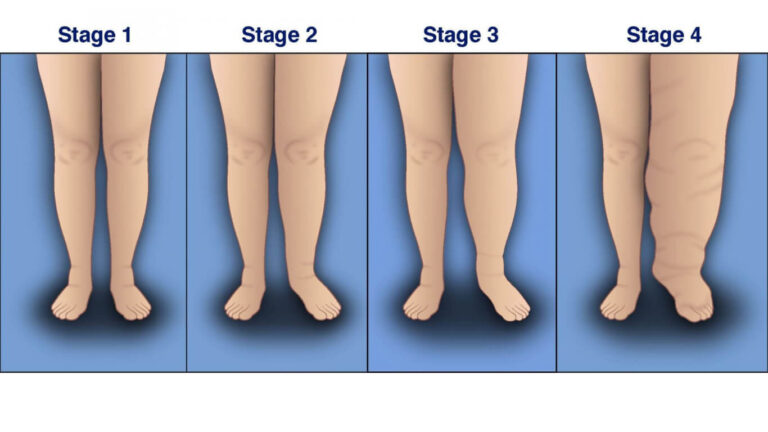 what are the four stages of lymphedema