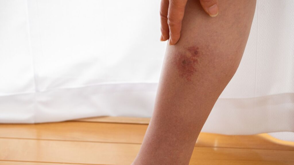 Lymphedema Management Through Occupational Therapy Solutions