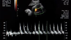 Evaluate Lymphedema The Role of Ultrasound in Diagnosis and Monitoring