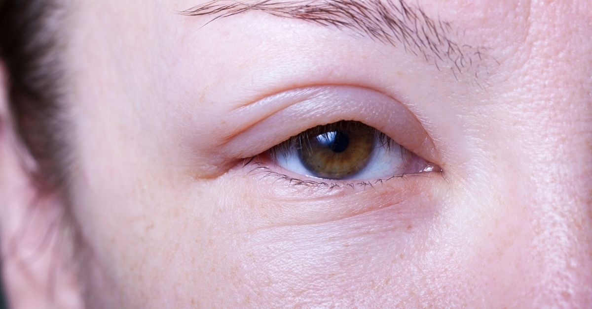 How to Manage Lymphedema Symptoms Without Medication