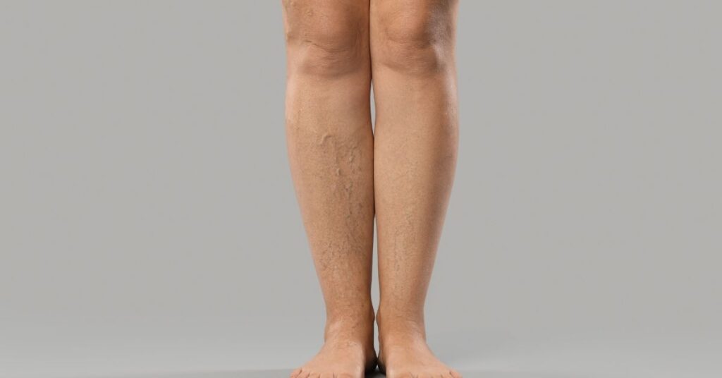 How to Track and Record Your Lymphedema Symptoms