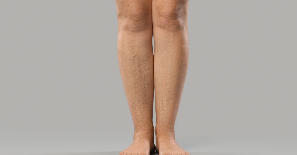 How to Track and Record Your Lymphedema Symptoms