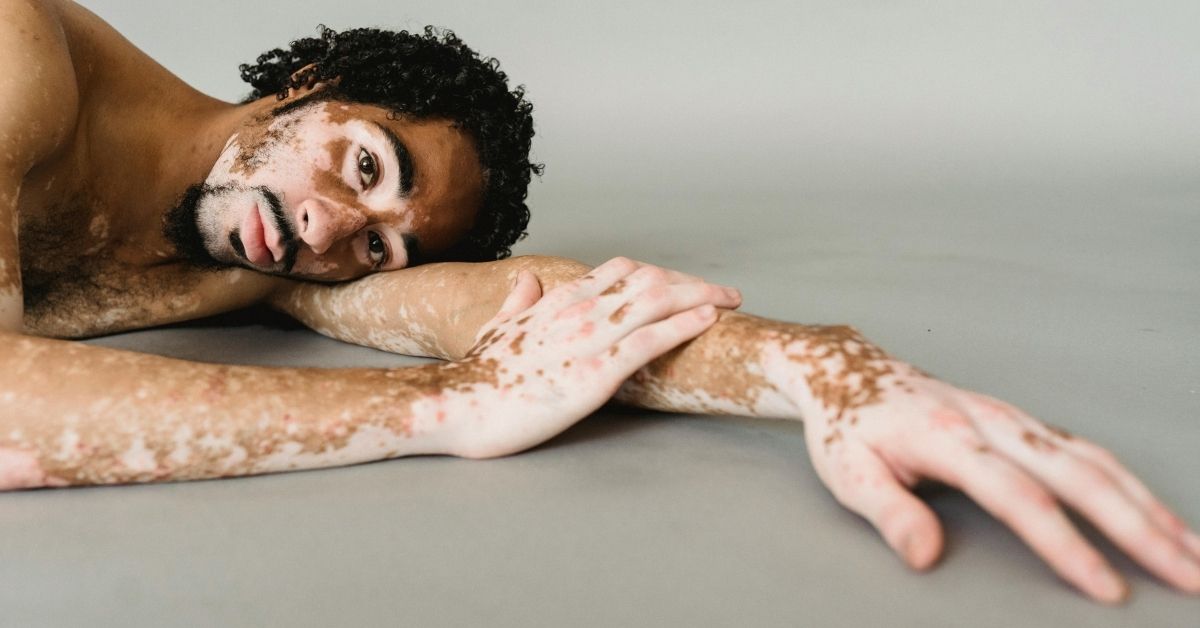 Understanding the Link Between Lymphedema and Autoimmunity
