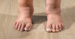 The Psychological Impact of Lymphedema and Coping Mechanisms