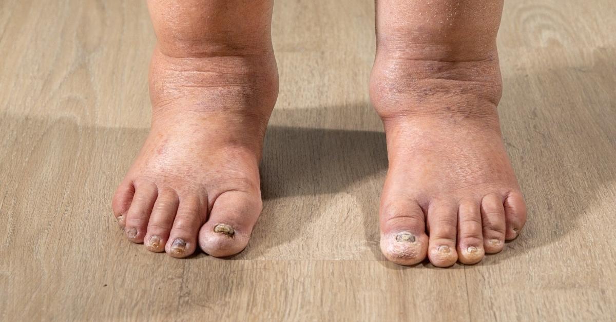 The Psychological Impact of Lymphedema and Coping Mechanisms