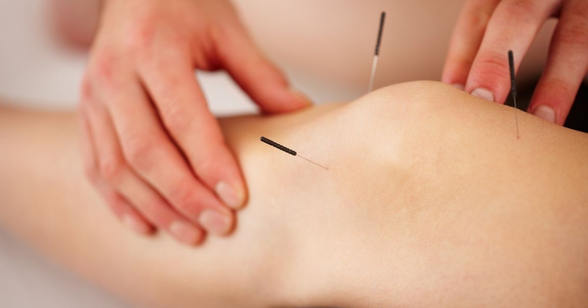 Lymphedema and the Role of Acupuncture in Treatment