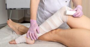 Lymphedema and the Role of Physical Therapy