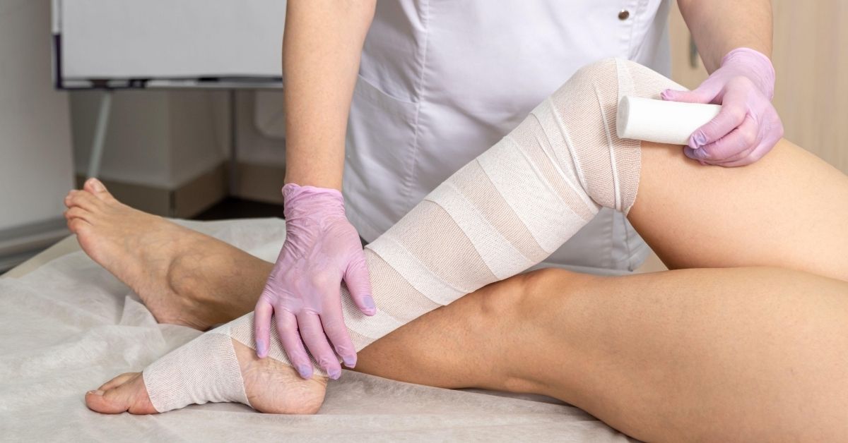 Lymphedema and the Role of Physical Therapy