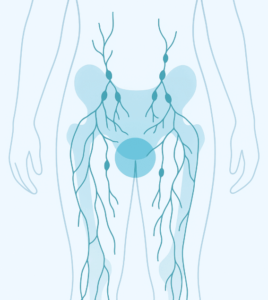 Genital Lymphedema: