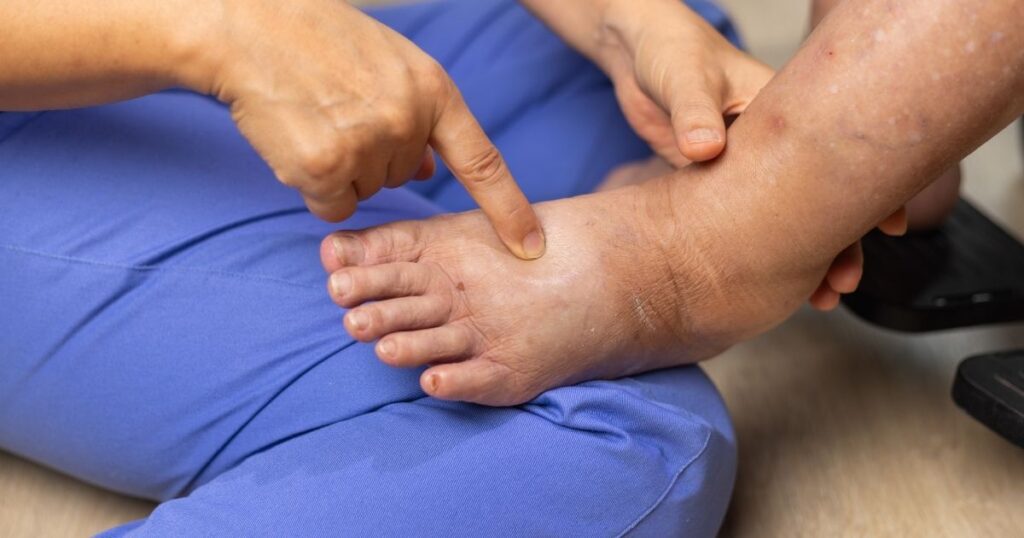 How to Protect Your Skin from Lymphedema Infections