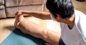 Lymphedema and Aging Managing Symptoms Effectively