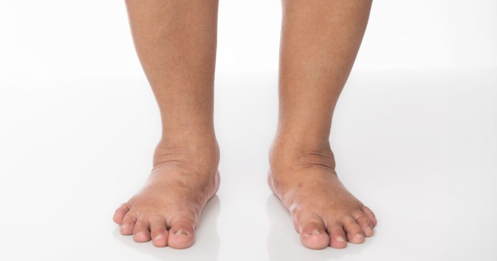 Lymphedema and Skin Sensitivity Causes, Care, and Treatment Tips