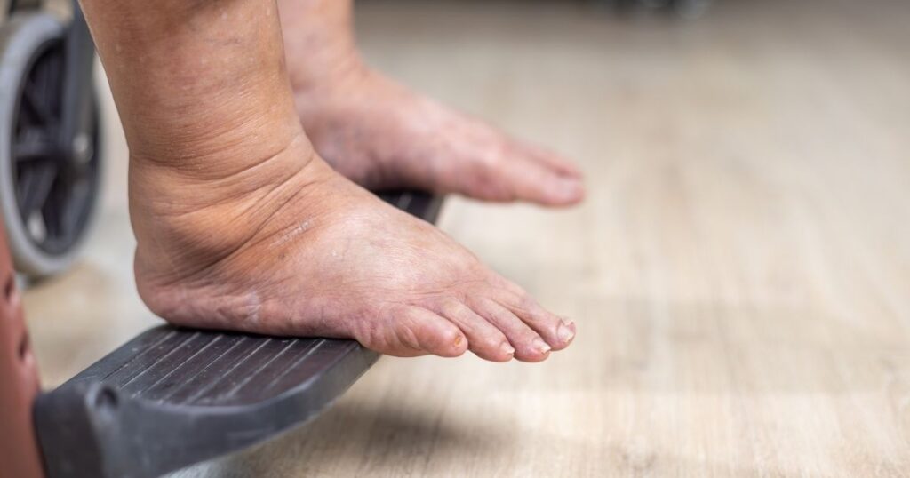 The Link Between Lymphedema and Cellulitis What Patients Need to Know