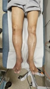 Clinical photo showing asymmetric lower limb swelling during lymphedema assessment