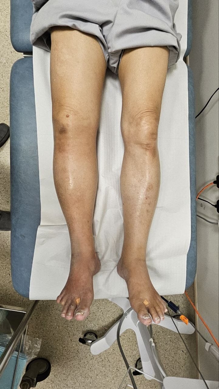 Clinical photo showing asymmetric lower limb swelling during lymphedema assessment