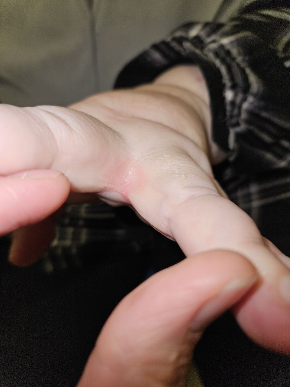 LymphedAsia Home 10 Finger webspace maceration showing a possible skin entry point for cellulitis