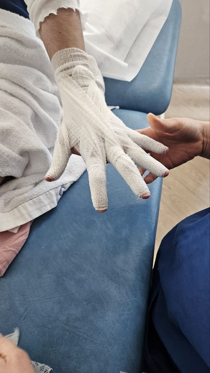 Finger wrapping during compression bandaging for upper limb lymphedema