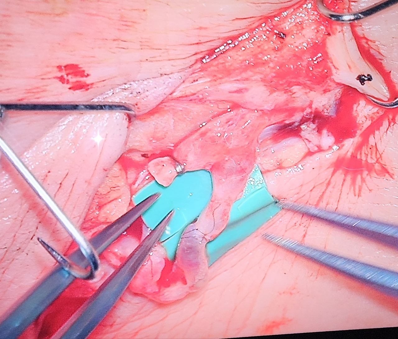 LymphedAsia Home 6 Intraoperative LVA showing lymphatic channel connected to a nearby vein