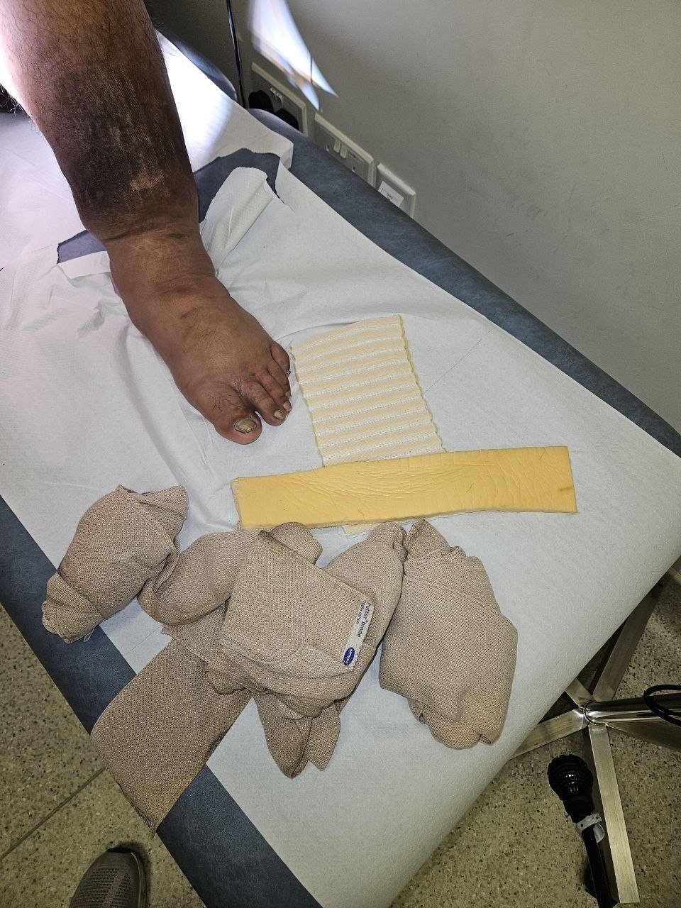 Lower limb lymphedema with compression garment and padding materials prepared for treatment