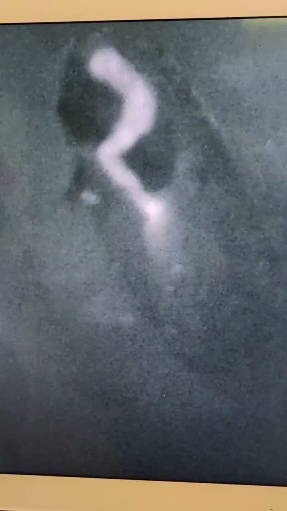 ICG lymphography still showing lymphatic flow during postoperative compression after LVA