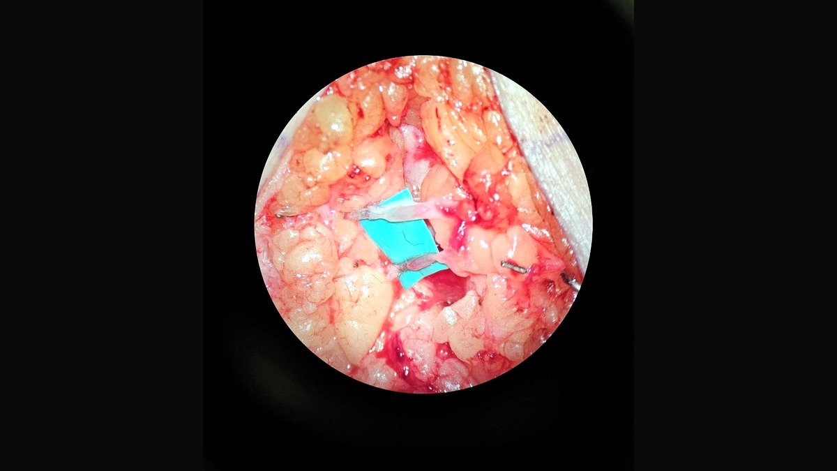 Intraoperative microscope view during supermicrosurgical lymphovenous anastomosis for lymphedema