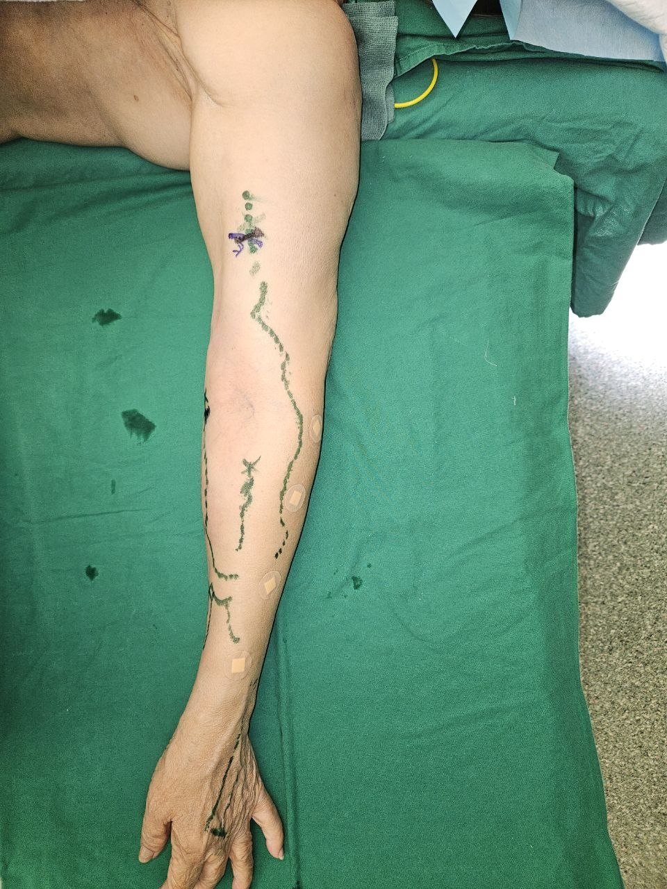 LVA Surgery in Singapore: Lymphaticovenous Anastomosis for Lymphedema 5 Arm with lymphatic mapping skin markings before LVA surgery