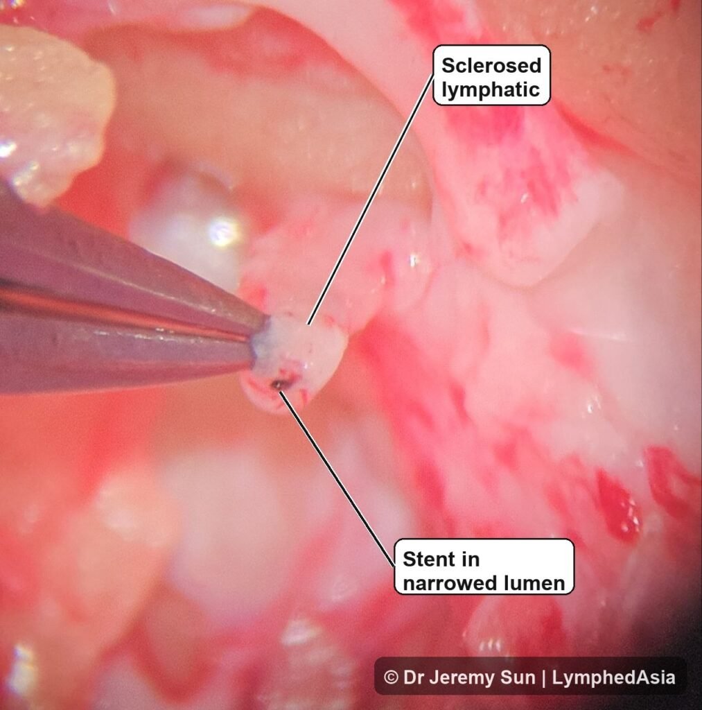 Sclerosed lymphatic vessel held with forceps, with a clean pointer line indicating a brown-black stent in a narrowed lumen during lymphatic surgery