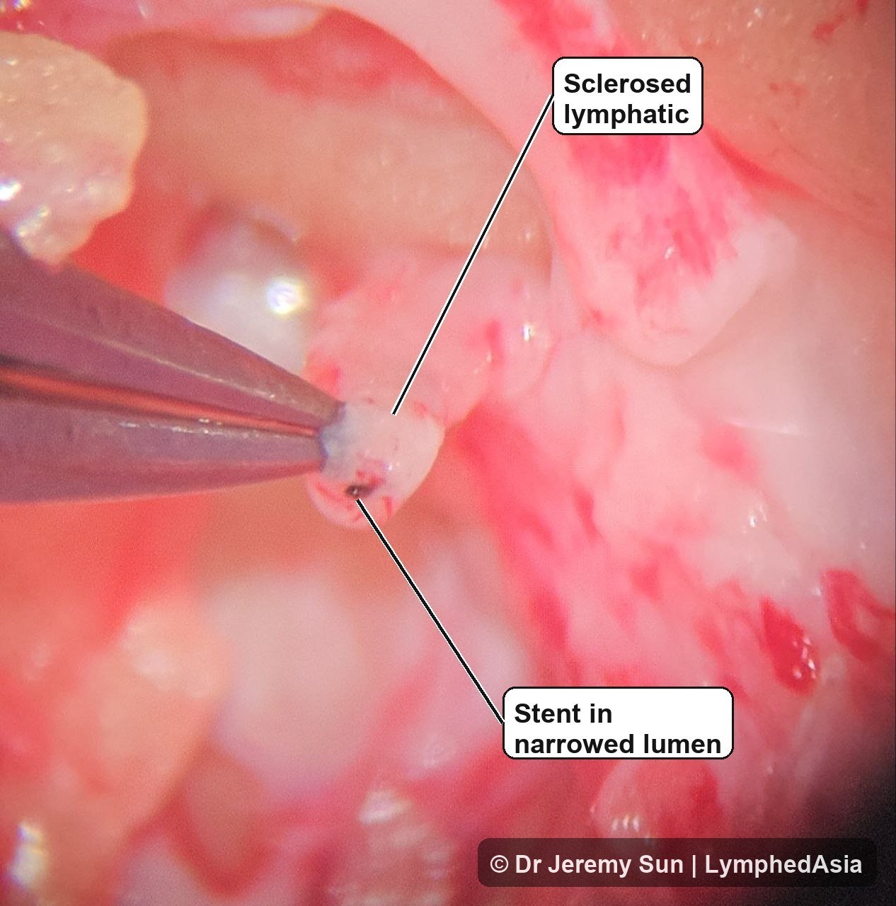 Sclerosed lymphatic vessel held with forceps, with a clean pointer line indicating a brown-black stent in a narrowed lumen during lymphatic surgery