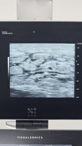 Ultrasound localisation of a lymphatic vessel for LVA planning