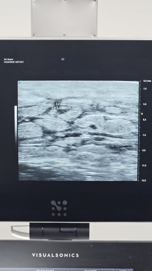 Ultrasound localisation of a lymphatic vessel for LVA planning