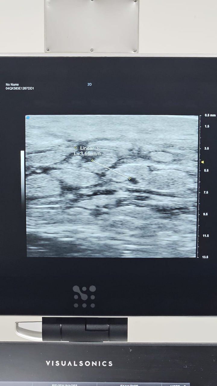 LVA Surgery in Singapore: Lymphaticovenous Anastomosis for Lymphedema 4 Ultrasound localisation image showing a superficial lymphatic channel or small vessel for LVA surgery planning