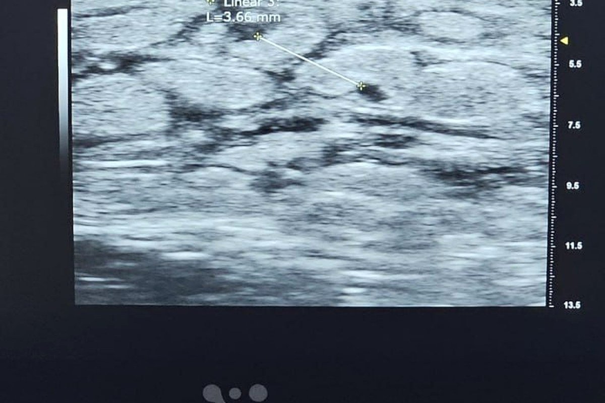 High-resolution ultrasound mapping of lymphatic vessels for LVA surgery planning