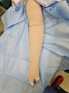 Arm with compression bandaging used in lymphedema treatment and swelling control