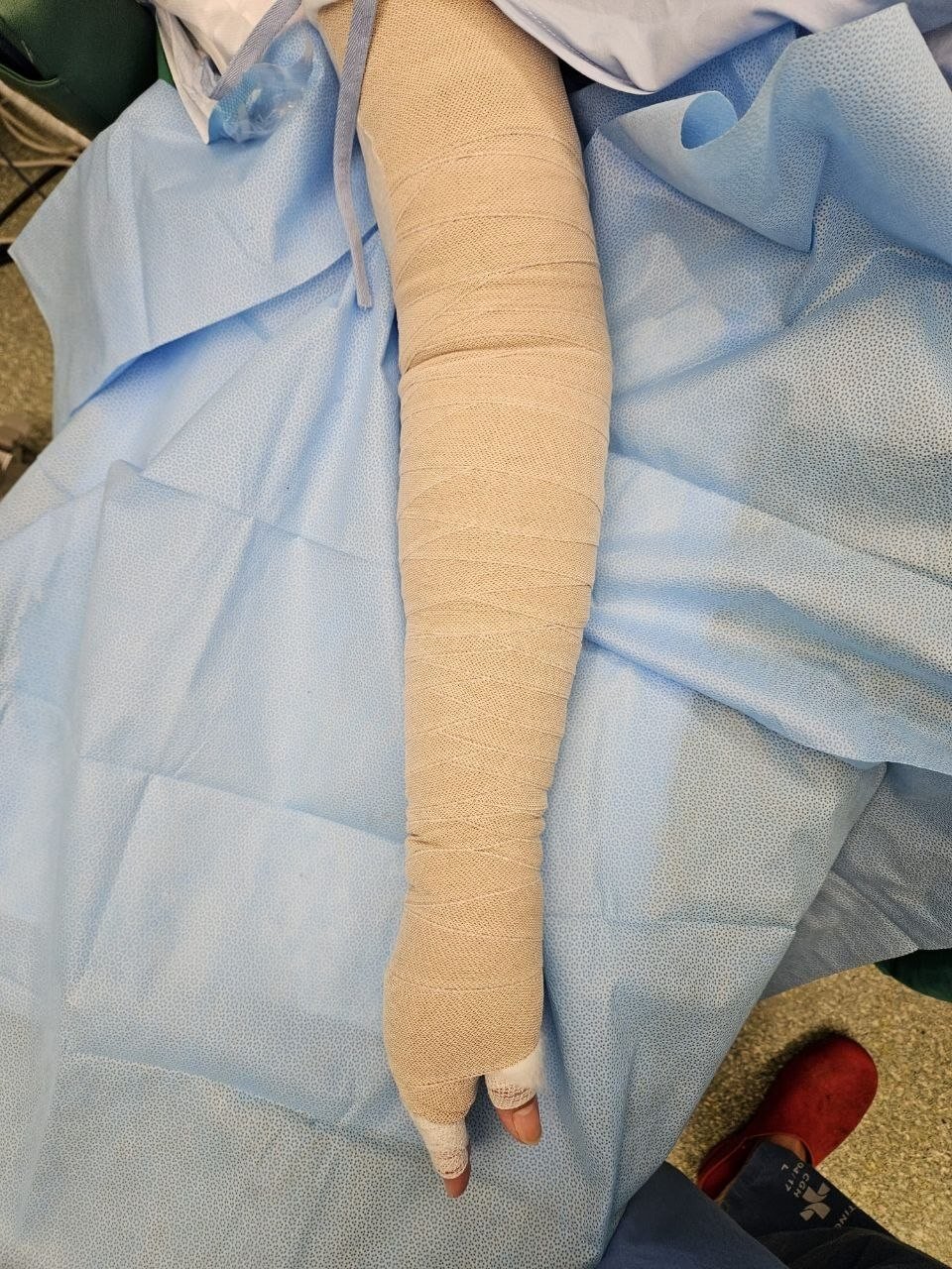 Arm with compression bandaging used in lymphedema treatment and swelling control